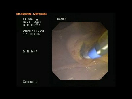 ERCP, CBD-Steine, Sphinkterotomie