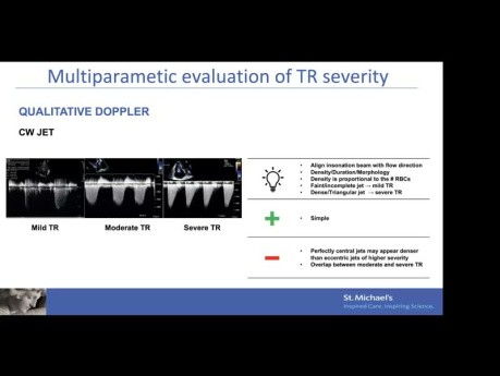 Echobeurteilung der Trikuspidalinsuffizienz – Mechanismus, Quantifizierung und Geräteauswahl