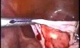 Die Ovarialzyste- Laparoskopie