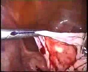 Die Ovarialzyste- Laparoskopie