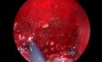 Adenoidektomie