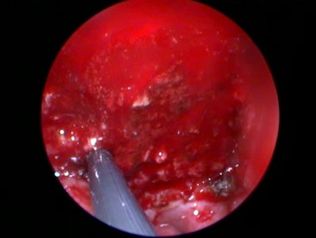Adenoidektomie