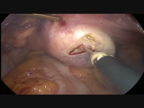 Torsion des rechten Eierstocks mit einer Zyste - Laparoskopie