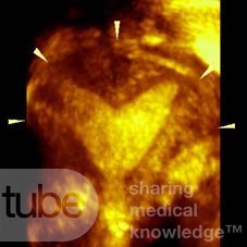 Uterus subseptus