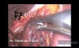 Laparoskopische Cholezystektomie bei kontrahierter Gallenblase