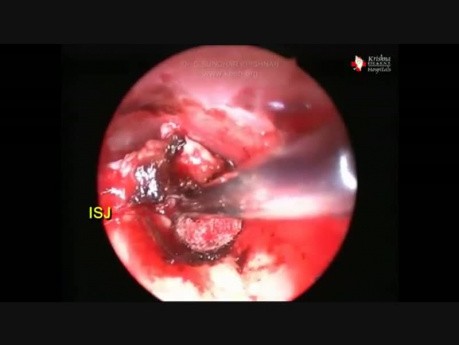 Endoskopische Exzision von Glomus Tympanicum