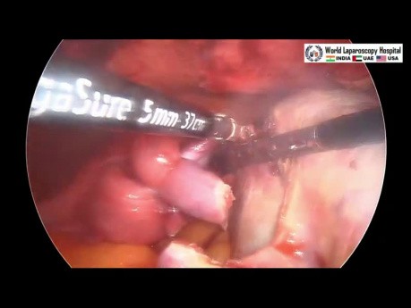 Laparoskopische Chirurgie bei der Ovarialtorsion