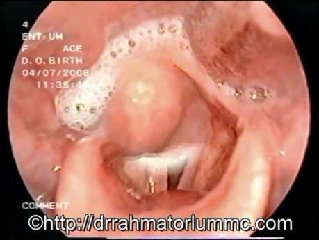 Speichelansammlung im Hypopharynx
