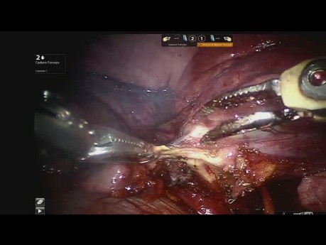 Läsion in der Pulmonalarterie während der linken unteren Lobektomie – Gefäßunfall