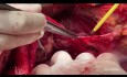 Die technischen Aspekte von Eingriffen im Oberbauch in der fortgeschrittenen Chirurgie des Eierstockkrebses