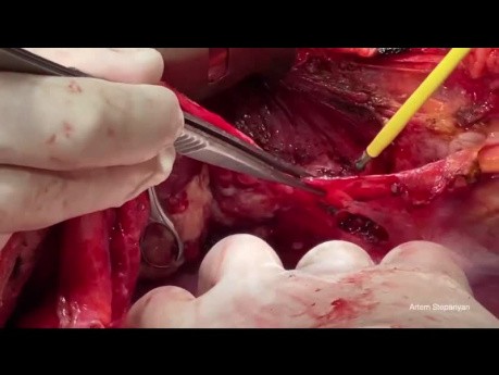 Die technischen Aspekte von Eingriffen im Oberbauch in der fortgeschrittenen Chirurgie des Eierstockkrebses