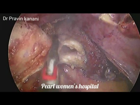 Laparoskopische Reparatur einer kolovesikalen Fistel