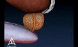 Biopsie der Prostatae 3D