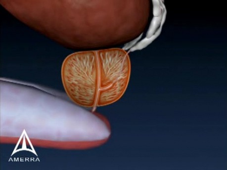 Biopsie der Prostatae 3D