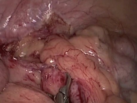 SILS-Methode bei der Appendektomie