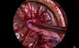 Vaginale Morcellation bei großem myomatösem Uterus