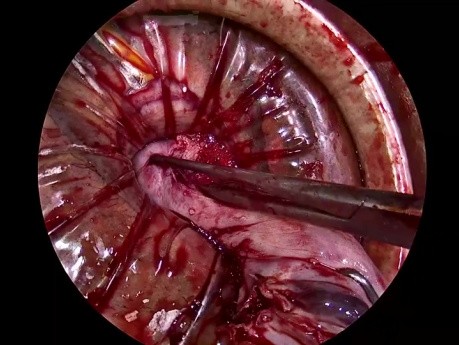 Vaginale Morcellation bei großem myomatösem Uterus