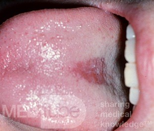 Mittlere rhomboide Glossitis
