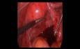 Blut in der Peritonealhöhle - ektopische Schwangerschaft - Laparoskopie