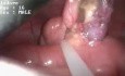 Appendektomie - SILS-Methode