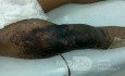 Schweres Trauma mit Reißen der Haut des rechten Oberschenkels 