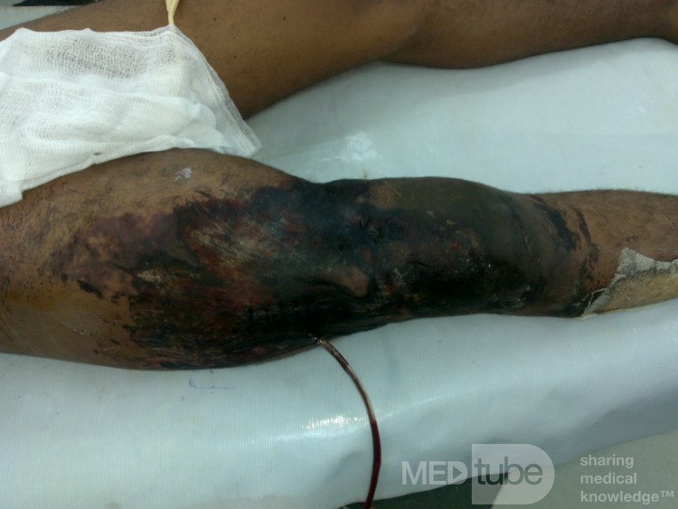 Schweres Trauma mit Reißen der Haut des rechten Oberschenkels 