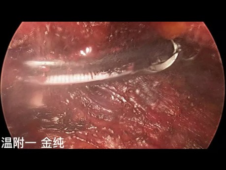 Trans-Subclavian Thyroid Endoskopische Chirurgie mit Dual-Port (Teil 2)