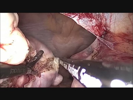 NOTES- Hysterektomie bei der Frau mit Uterus fibromatosus