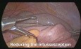 Laparoskopische Intussuszeptionschirurgie