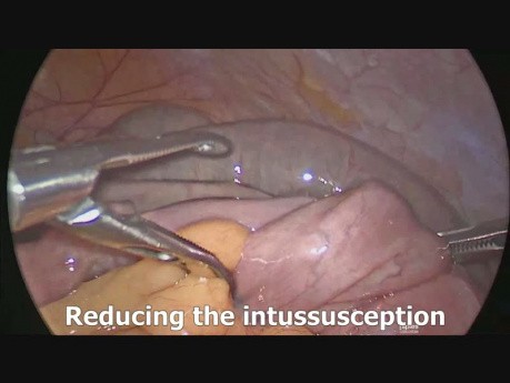 Laparoskopische Intussuszeptionschirurgie