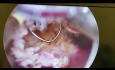 Hysteroskopische Resektion des intrauterinen Septums nach wiederholten Fehlgeburten