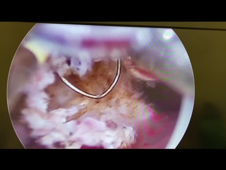 Hysteroskopische Resektion des intrauterinen Septums nach wiederholten Fehlgeburten