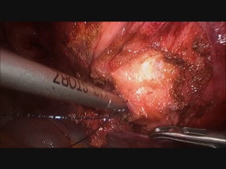 TAPP oder TARM (transabdominale retromuskuläre Netzhernioplastik) bei Narbenhernie