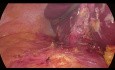 Laparoskopische Drainage des Leberabszesses und Cholezystektomie bei Adipositas permagna (BMI 70)