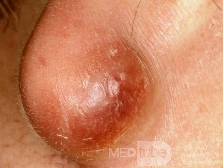 Infizierte Epidermoidzyste