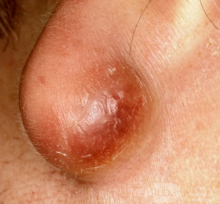 Infizierte Epidermoidzyste