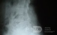 Spondylolisthesis L4-5