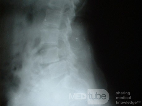 Spondylolisthesis L4-5