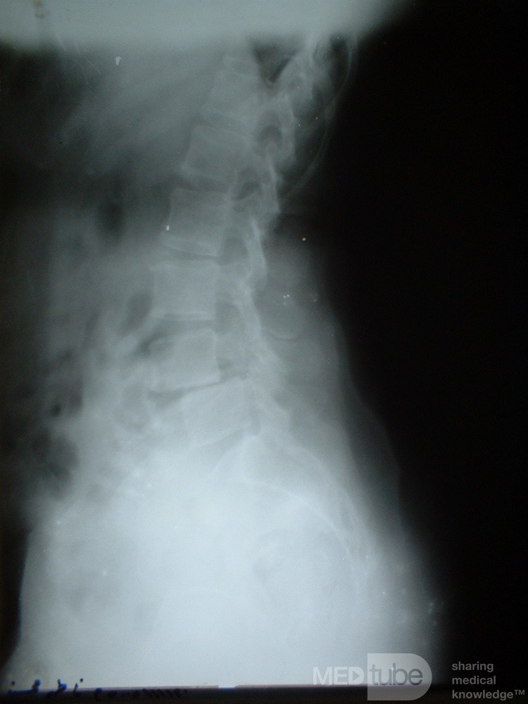 Spondylolisthesis L4-5