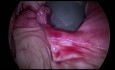 das Morcellieren in Gynekologie