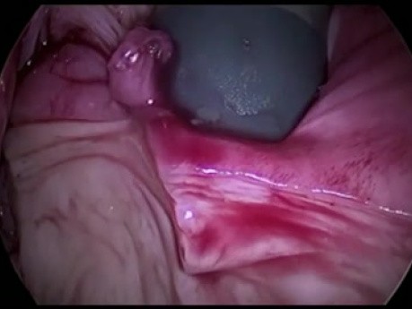 das Morcellieren in Gynekologie