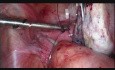 Behandlung von Ovarialhämatom und Hämoperitoneum
