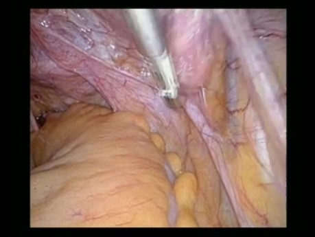 Totale laparoskopische Histerektomie (TLH)