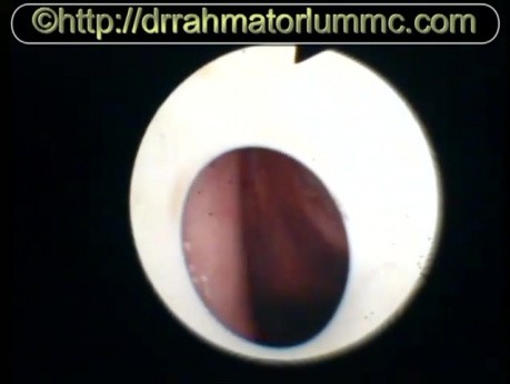 Der Blick auf die echtenSchwingungen der Stimmlippen durch das T-Tube
