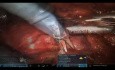 Roboterassistierte partielle Nephrektomie bei Hufeisenniere