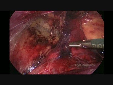 Laparoskopische Leistenhernienkorrektur mit der TAPP-Technik