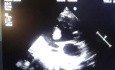 Riesiger Thrombus im linken Ventrikel