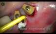 Extraktion und Sofortimplantation mit Lasern