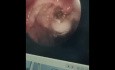 Endoskopische Coblation-gestützte Adenoidektomie