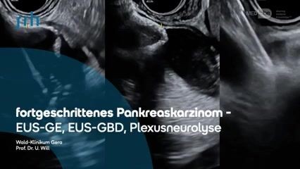 EUS-GE, EUS-GBD sowie Plexusneurolyse bei fortgeschrittenem Pankreaskarzinom